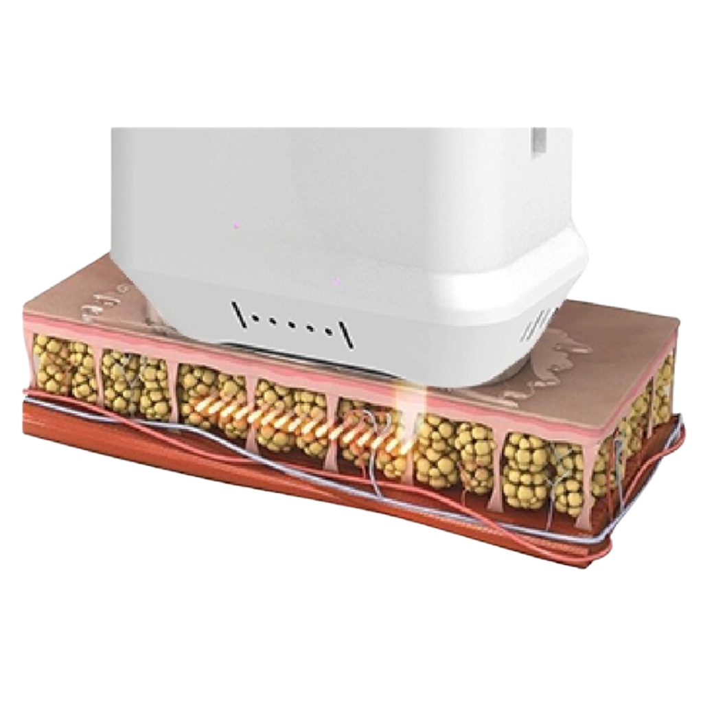 The effect of HIFU is verified and recognized by the market.