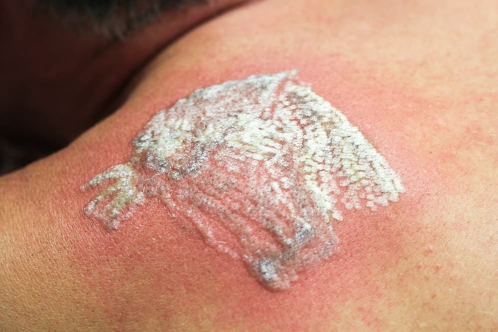 tattoo removal aftercare